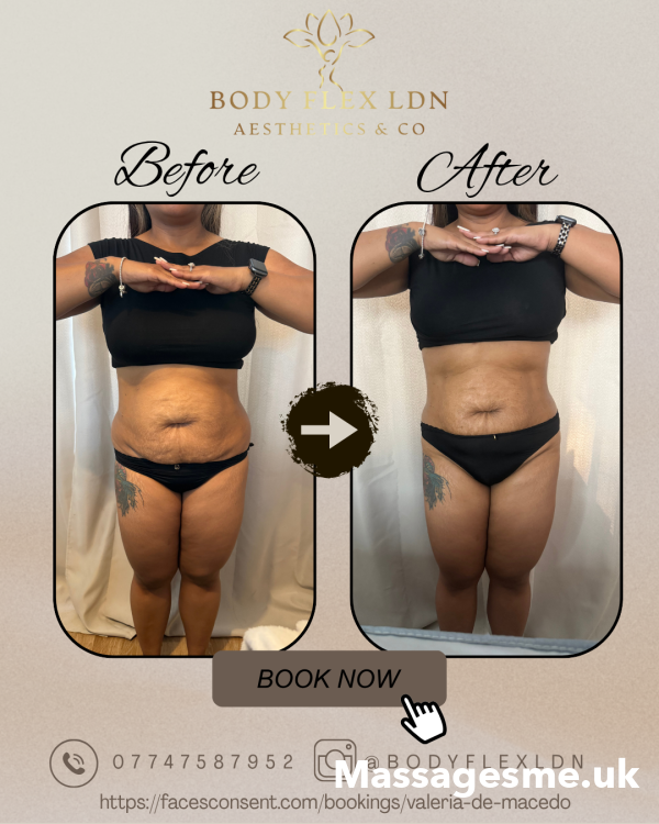 Body Flex LDN – Expert Body Sculpting & Massage Therapy In Uxbridge, West London